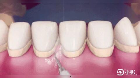 隐形牙套视频